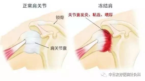 肩周炎vs肩袖损伤 到底谁更厉害 健康频道 手机搜狐